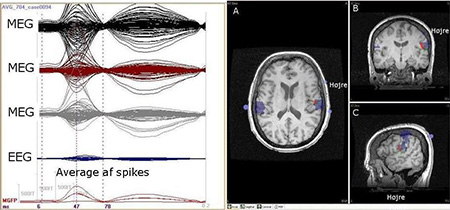 Data fra MEG-undersøgelse