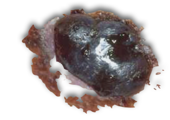 Ulcerated melanoma