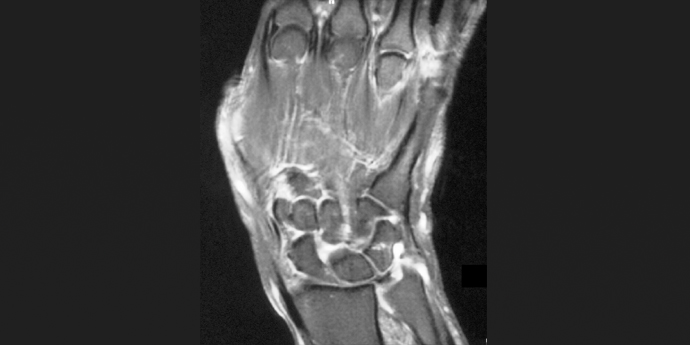 Rheumatioid arthritis 690x345.jpg