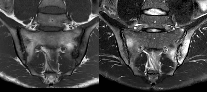 Manifest rheumatic sacroiliitis 690x308.jpg