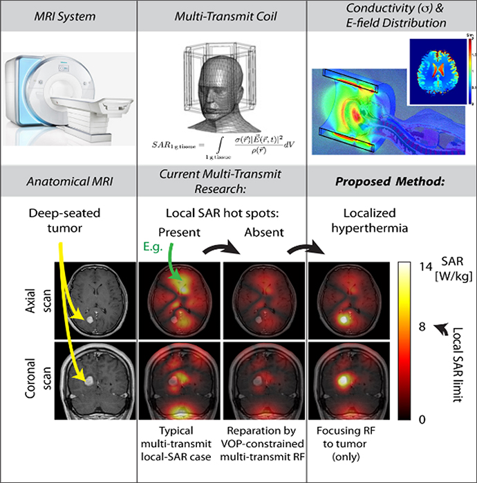 Treating brain lesions and tumors by MR.jpg