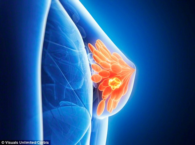 Hyperthyroidism linked to greater risk of breast cancer